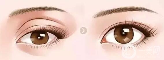 雙眼皮手術(shù)有哪幾種?具體有什么