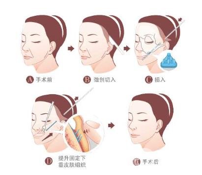 下筋膜懸吊祛皺術(shù)怎么操作的？*果嗎？