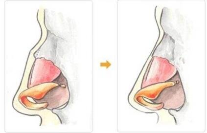 歪鼻矯正手術(shù)
