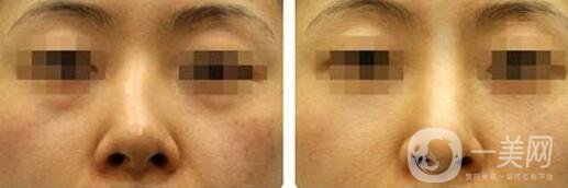 歪鼻矯正手術(shù)