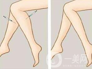 *瘦小腿一般多少錢？