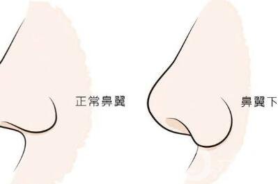 鼻翼缺損矯正*大嗎？要多少錢？