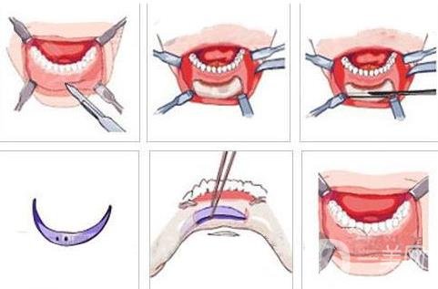 膨體隆下巴多久會(huì)變軟？容易取出來(lái)嗎？