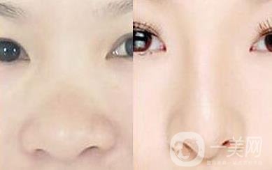 鼻頭縮小手術(shù)