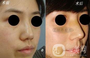 韓式肋軟骨隆鼻