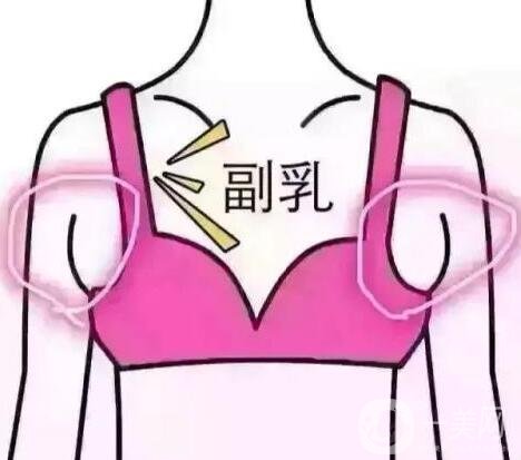 腋下副乳手術(shù)的價(jià)格是多少?影響因素有哪些呢?