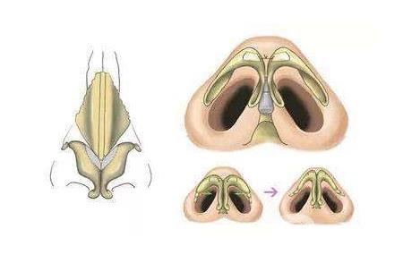鼻頭肥大縮小術(shù)是持久*的嗎？