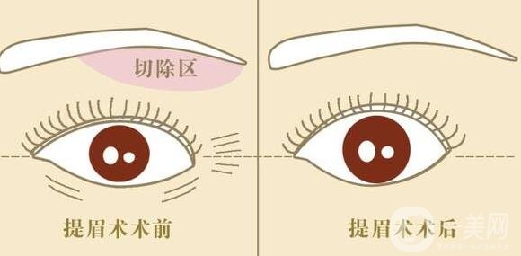 眉提升術(shù)適合哪些人?有什么方法