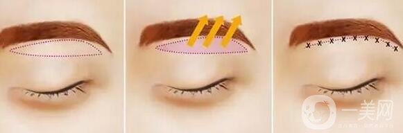 眉提升術(shù)適合哪些人?有什么方法