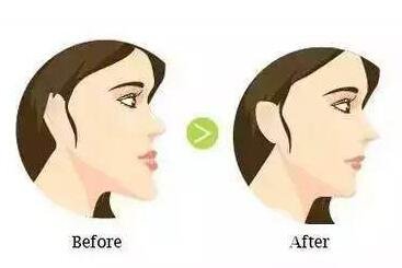 上頜后縮怎么矯正？手術(shù)有風(fēng)險(xiǎn)嗎？