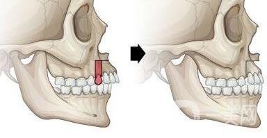 上頜后縮怎么矯正？手術(shù)有風(fēng)險(xiǎn)嗎？