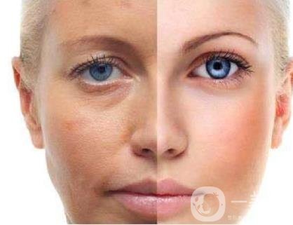 激光祛斑好嗎？需要打麻藥嗎？