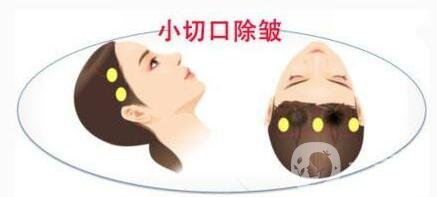 小切口除皺術(shù)后恢復(fù)過程是怎樣的？