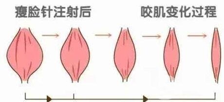 咬肌切除手術和*信息介紹些?