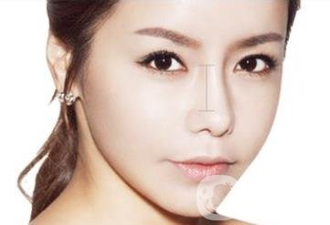 鷹鉤鼻矯正術(shù)后注意事項(xiàng)有哪些？