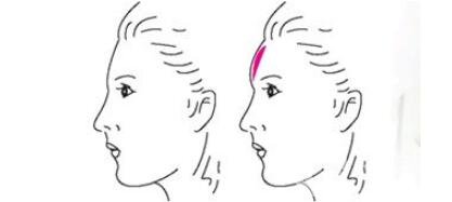 額部填充術(shù)