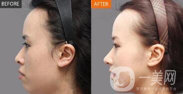 額部填充術(shù)