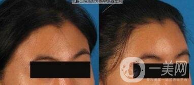 額部填充術(shù)