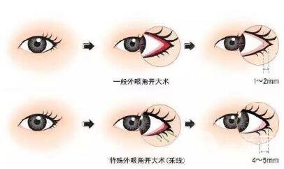 開外眼角會(huì)留疤嗎？留疤了怎么辦？