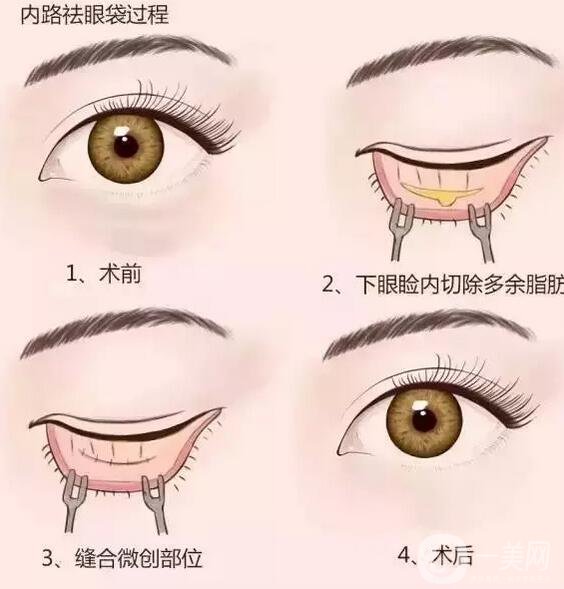 外切去眼袋后恢復(fù)期應(yīng)該注意什么?