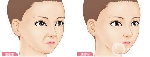 自體脂肪豐鼻唇溝*果怎么樣?能*保持嗎?