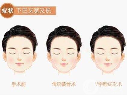 下頜角手術(shù)術(shù)后護(hù)理要注意哪些？