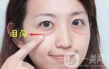 玻尿酸豐淚溝有危險(xiǎn)嗎？能管多久？