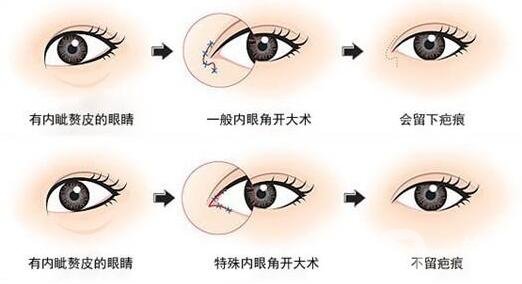 韓式開眼角手術*果怎么樣?看前后圖