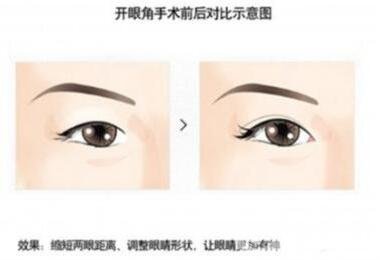 韓式開眼角手術*果怎么樣?看前后圖
