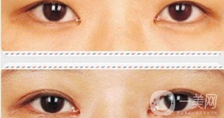 開內(nèi)眼角后遺癥