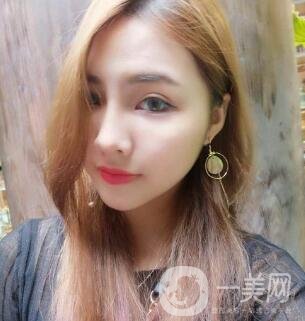 開內(nèi)眼角后遺癥