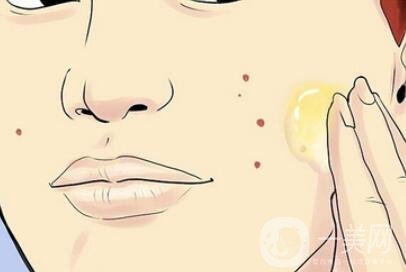 激光治痘疤要做幾次？多久見*？