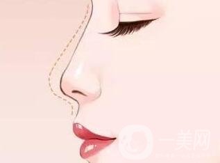 硅膠隆鼻假體取出術后護理注意事項有哪些呢?