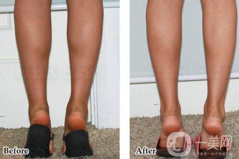 神經(jīng)瘦小腿