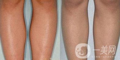 神經(jīng)瘦小腿