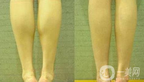 神經(jīng)瘦小腿
