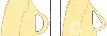 水滴型假體隆胸