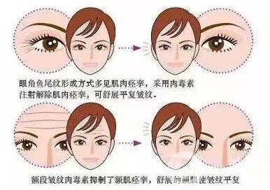 填充式注射除皺*果好嗎?可以保持多久?