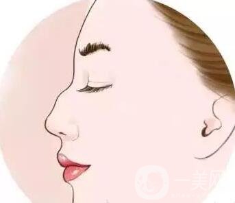 駝峰鼻矯正價(jià)錢貴嗎?大概是多少?