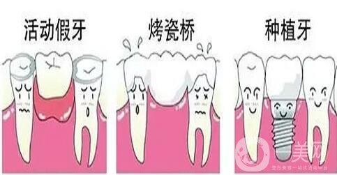 鑲牙的種類各有什么優(yōu)缺點