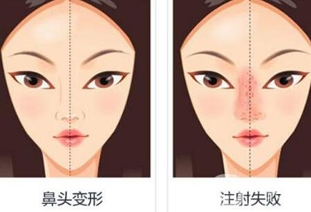 注射隆鼻失敗了怎么辦?如何修復(fù)?