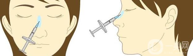 注射隆鼻失敗了怎么辦?如何修復(fù)?