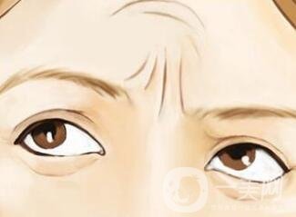 抬頭紋手術價格