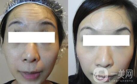 抬頭紋手術價格