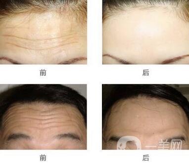 抬頭紋手術價格