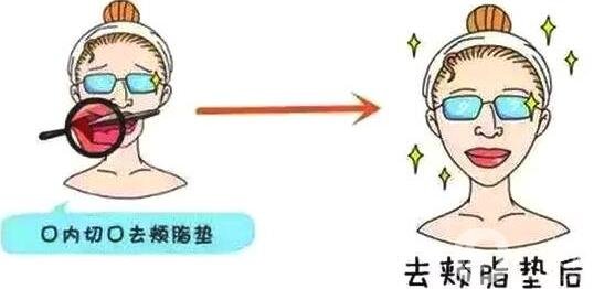 去頰脂墊有副作用嗎?術(shù)后該怎樣進(jìn)行護(hù)理?