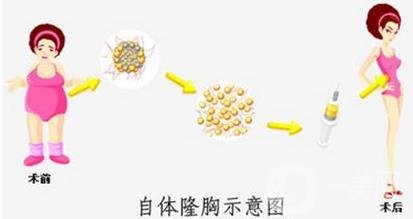 自體隆胸手術(shù)失敗修復(fù)注意事項