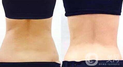 360度吸脂減肥是指環(huán)吸還是水動力？