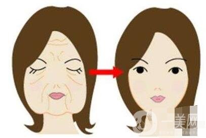 大拉皮除皺恢復(fù)時(shí)間要多久?可以做第二次嗎?