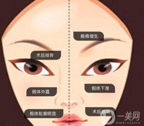 墊高鼻子的風險有多大?后遺癥有哪些?